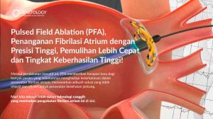 Pulsed Field Ablation (PFA): Inovasi Revolusioner dalam Pengobatan Fibrilasi Atrium
