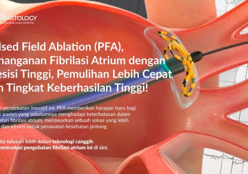 Pulsed Field Ablation (PFA): Inovasi Revolusioner dalam Pengobatan Fibrilasi Atrium