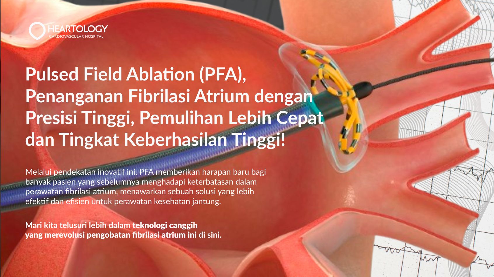 Pulsed Field Ablation (PFA): Inovasi Revolusioner dalam Pengobatan Fibrilasi Atrium