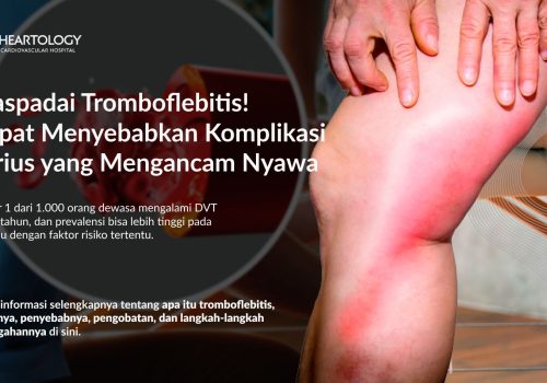 Tromboflebitis: Gejala, Penyebab, Pengobatan dan Pencegahannya