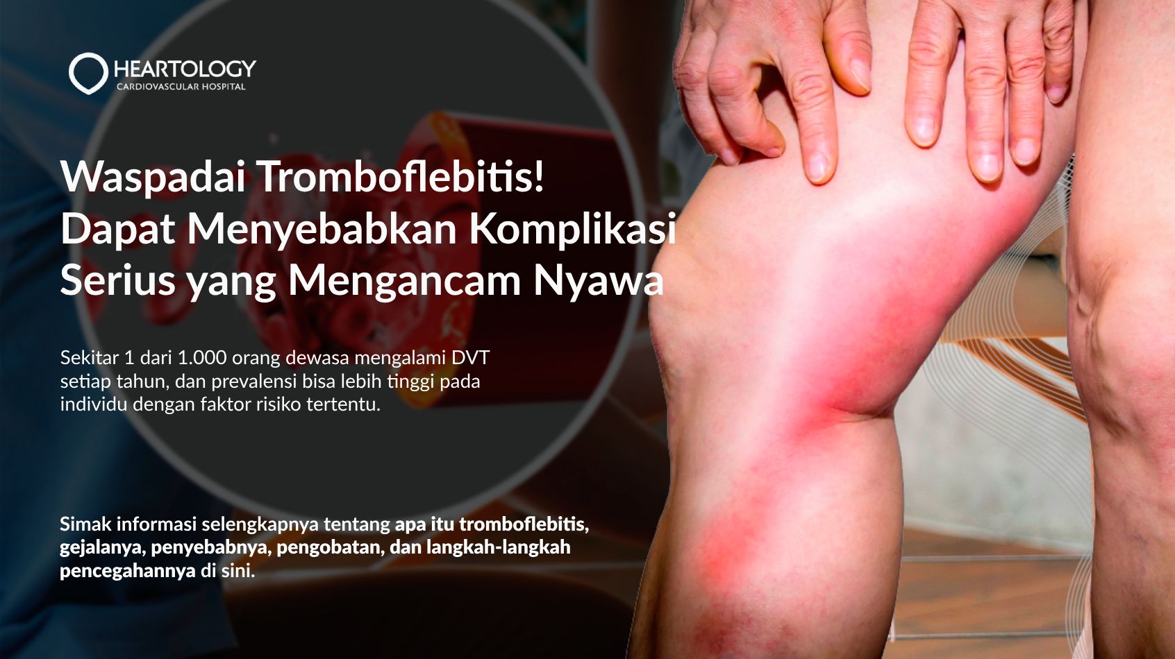 Tromboflebitis: Gejala, Penyebab, Pengobatan dan Pencegahannya