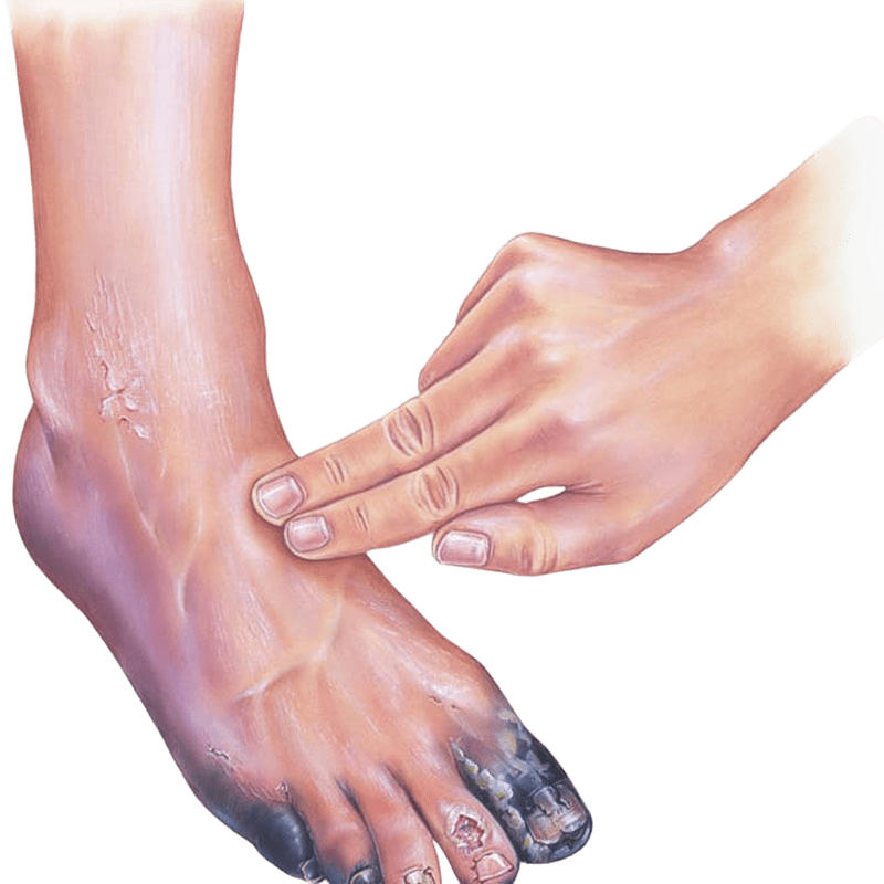 Gangrene: Gejala, Penyebab, Pengobatan dan Pencegahannya