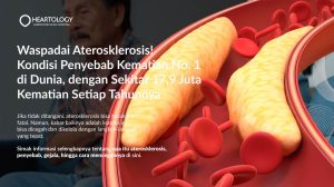 Aterosklerosis: Gejala, Penyebab, Pengobatan dan Pencegahannya