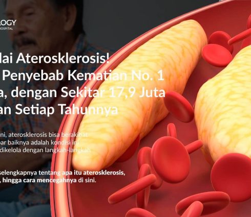 Aterosklerosis: Gejala, Penyebab, Pengobatan dan Pencegahannya