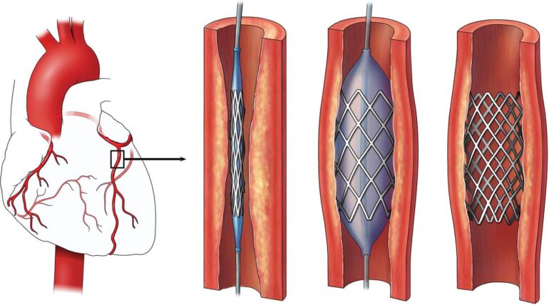 Diagram Ilustrasi Prosedur Pemasangan Ring Jantung / Stent (PCI)