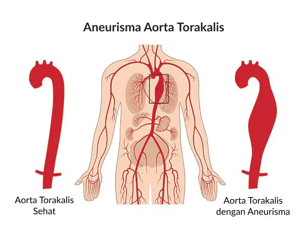 Gambar Ilustrasi Medis Aneurisma Aorta Torakalis