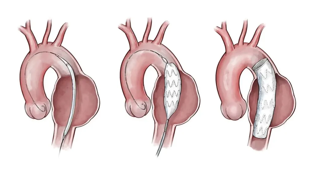 Gambar Ilustrasi Medis Prosedur TEVAR (Thoracic Endovascular Aneurysm Repair) - Sumber: Stanford Medicine